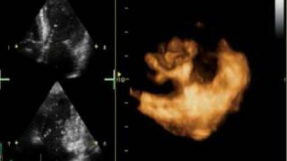 3D MITRAL REGURGITATION PROLAPSE P2 AND P3 [upl. by Eked]