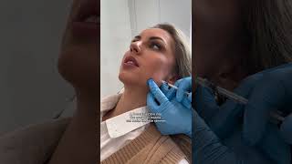 Masseter botox against grinding and clenching [upl. by Idur]