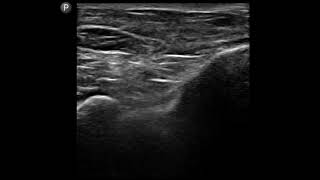 Ankle Ultrasound Tibiotalar Ankle Joint Injection [upl. by Ayanet951]