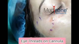 EYE THREADS ON CANNULA [upl. by Ellenrahc]