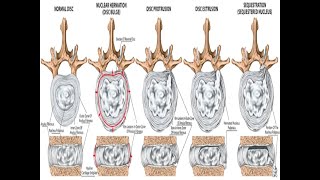 Degenerative Spine 1  Spine Degeneration and Disc Prolapse الانزلاق الغضروفي و خشونة الفقرات [upl. by Snahc]