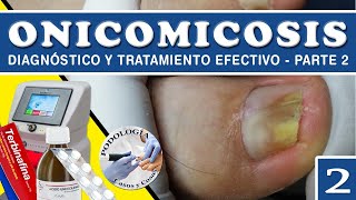 PARTE 2 ONICOMICOSIS  Diagnóstico y Tratamiento Efectivo  Podología Casos y Cosas [upl. by Aitnuahs]