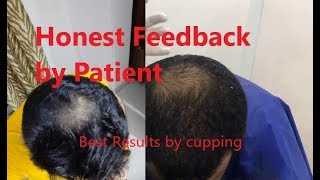 Honest feedback of patient after 2 sessions of cupping Hijama for hair regrowth Hair fall at delhi [upl. by Behre]