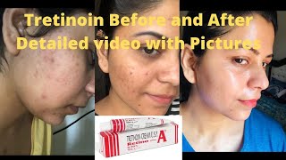 Tretinoin Journey With Results tretinoin clearskin skincare result beauty acne [upl. by Chessa]