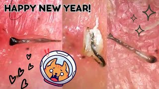 Hair Follicle Plucks Under the Microscope Super Satisfying Ingrown Hair Removal  BIG Hair Roots [upl. by Seidule]