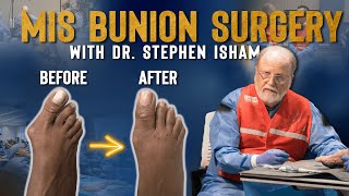 Minimally Invasive Bunion Surgery  Dr TJ Ahn [upl. by Thun]