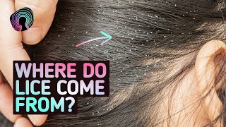 Your Body On Lice Warning Distressing Footage [upl. by Aciraj]