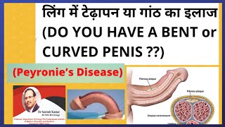 ling me dard ganth aur tedhapan peyronies disease  peyronies disease टेढ़ा लिंगDrSantosh Kumar PGI [upl. by Blanding85]