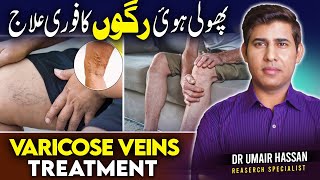 Best Ways to Get Rid of Varicose Veins TESTED│Dr Umair [upl. by Ahsekel]