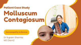 Successful Case Study of Molluscum Contagiosum Dr Rupam Sharma Homoeopathy [upl. by Aniale317]