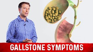 Gallstone Symptoms and Causes Explained – DrBerg on Gallbladder Stone Removal [upl. by Acila532]