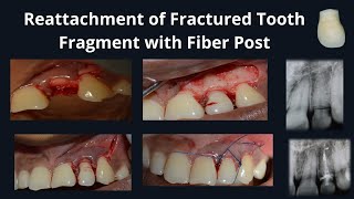 Tooth Fragment Reattachment  How to fix a broken tooth  Crown Fracture  Dental Trauma [upl. by Davin]