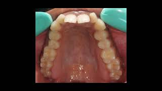 orthodontics Treatment planning Part 3 Class 2 div 1 malocclusion Orthodontic Courses Lecture [upl. by Hernando]