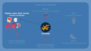 Overcoming Challenges in the Diagnosis and Treatment of Invasive Fungal Infections [upl. by Eilime803]