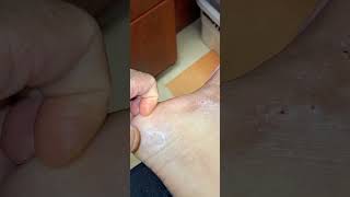 why is eczema so itchy [upl. by Zebulen]