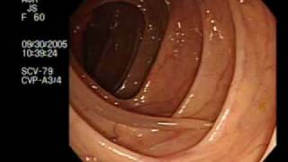 Colonoscopy Demonstrating a Moving Worm  NEJM [upl. by Hanid217]