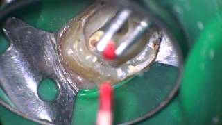 Squirt obturation of an upper molar with joining root canals [upl. by Bertie]