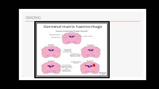 Intraventricular haemorrhage ivh germinal matrix hemorrhage Periventricular leucomalcia [upl. by Aracat]