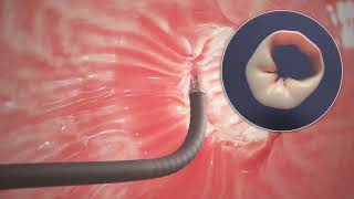 Endoscopic Sleeve Gastroplasty ESG Procedure Animation [upl. by Francie257]