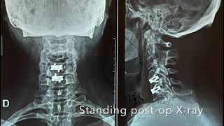 Endoscopic cervical anterior discectomy and fusion ACDF at C4C5 and C5C6 [upl. by Ahsahs601]