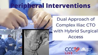 Dual Approach of Complex Iliac CTO with Hybrid Surgical Access [upl. by Kolb]