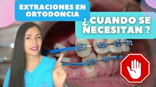 Extraciones en ortodonciabrackets 7 Razones para hacerlas [upl. by Salomo820]