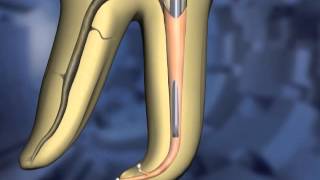 Continuous Wave technique  Dentsply Sirona [upl. by Gibbs]