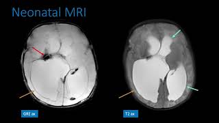 Germinal Matrix Hemorrhage Pre and Postnatal Image Findings [upl. by Alayne]