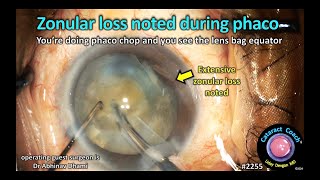 CataractCoach™ 2255 zonular loss noted during phaco [upl. by Teressa]