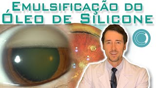 Emulsificação do óleo de silicone após cirurgia de retina [upl. by Ogu211]