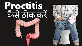 Proctitis symptoms and treatment in Hindi  proctitis kya hai  proctitis ka ilaaj [upl. by Sibylla301]