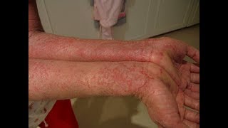 Treatment of eczema and other skin diseases [upl. by Selrhc]