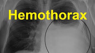 Hemothorax Symptoms Causes and Treatment [upl. by Elvis602]