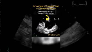 Involvement of Tricuspid Valve in Carcinoid Syndrome echocardiography [upl. by Sylvanus]