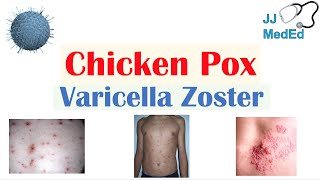 Chickenpox  Varicella Zoster Virus  Pathogenesis Signs and Symptoms Diagnosis and Treatment [upl. by Belldame]