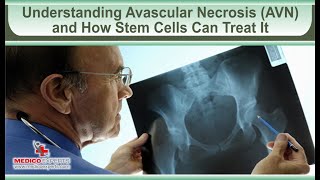 Understanding Avascular Necrosis AVN and How Stem Cells Can Treat It [upl. by Lime]