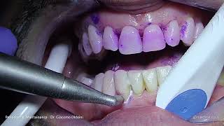 PROPHYLAXIS  Dr Giacomo Oldoini  Periodontal Mantainance [upl. by Dougie]