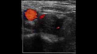 DVT of the rt common femoral vein Transverse scan [upl. by Symons95]