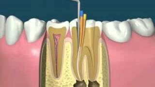 traitement endodontiquedevitalisationflv [upl. by Ativel]