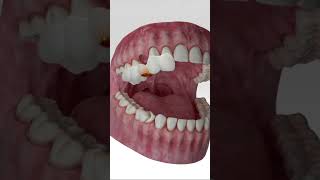 Digital Dental Implant Workflow dentist custom [upl. by Neerak605]