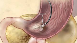 Infected Necrotizing Pancreatitis  Treatment By Endoscopic Transgastric Necrosectomy [upl. by Larentia]