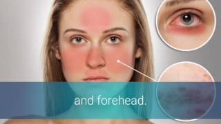 Rosacea And Lupus [upl. by Lowrance]