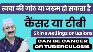 Skin swellings amp lesions त्वचा की गांठे और जख्म [upl. by Enilraep346]