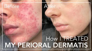 My PERIORAL DERMATITIS Experience  Storytime and TREATMENT  Alex C [upl. by Mercorr]