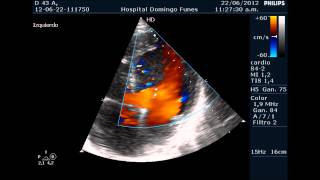 Miocardiopatia No compactada en varon de 43 anos Dr Pedro Guillermo Bustos [upl. by Sinnej]