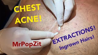 Chest congestionblackheads whiteheads ingrown hairs Multiple plugs extracted patient left happy [upl. by Tallie]