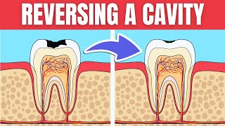 How To Reverse a Cavity Naturally at Home Cure Tooth Decay [upl. by Moishe]