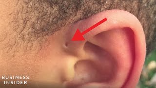 Explaining A Preauricular Sinus A Tiny Hole Above Some Peoples Ears [upl. by Onimixam]