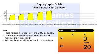 Capnography Waveforms Rapid Increase in EtCO2 [upl. by Coopersmith974]