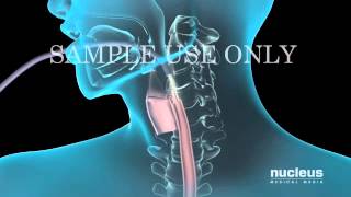 Upper Gastrointestinal Endoscopy EGD [upl. by Phebe]